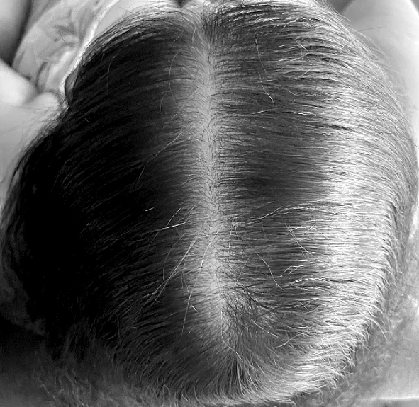 Depois do tratamento